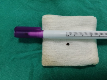 HASTANIN KULAĞINDAN KENE ÇIKTI