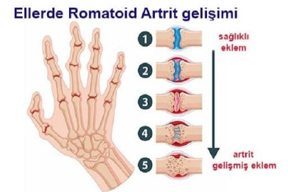 12 EKİM DÜNYA ARTRİT GÜNÜNDE BEL AĞRILARINA DİKKAT